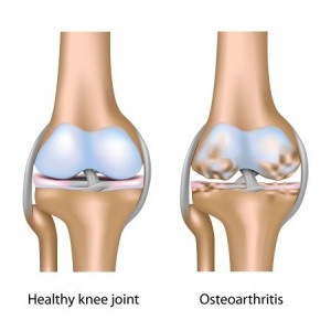 Osteomyelitis